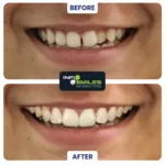 Teeth braces before and after results Surat