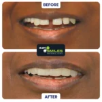 Dental implant before and after transformation Surat
