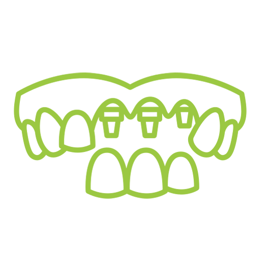 All-on-4 Implants