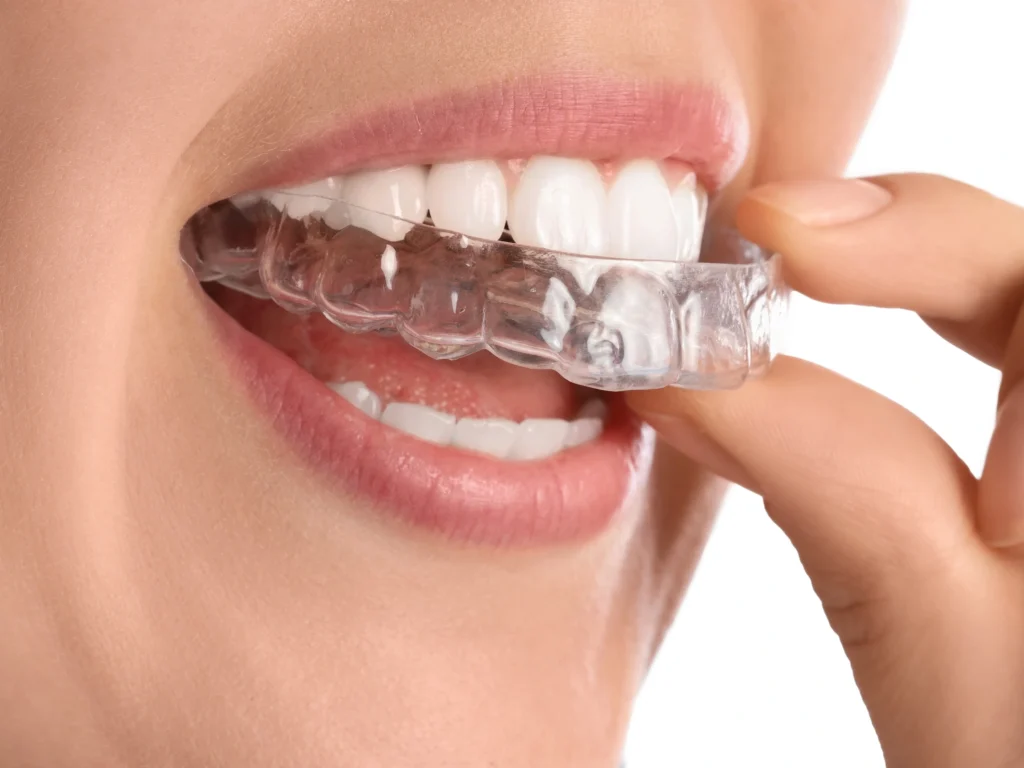 Invisible Aligners