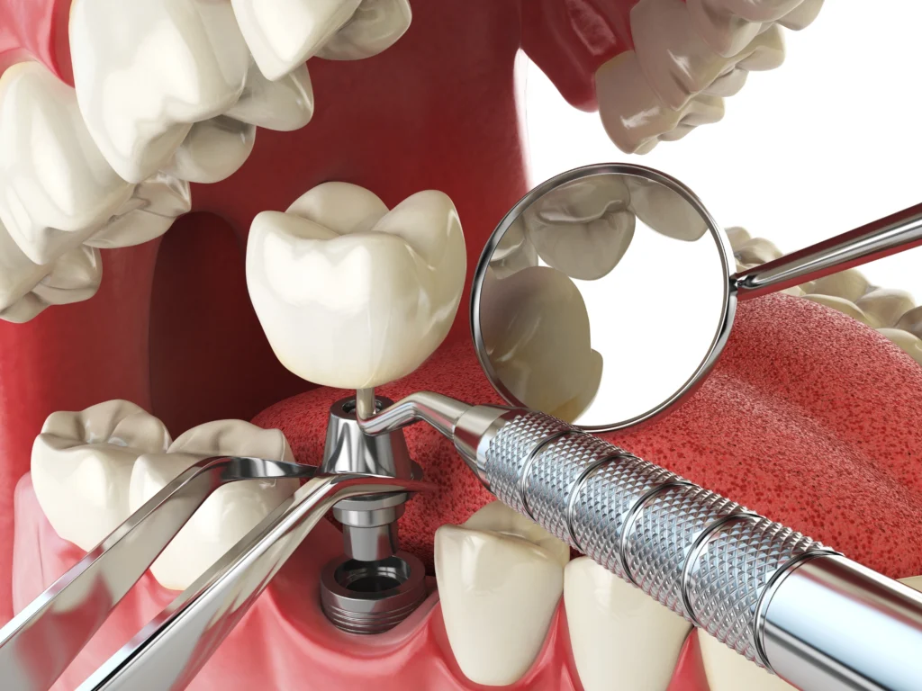 Jawbone deterioration (Bone Loss)