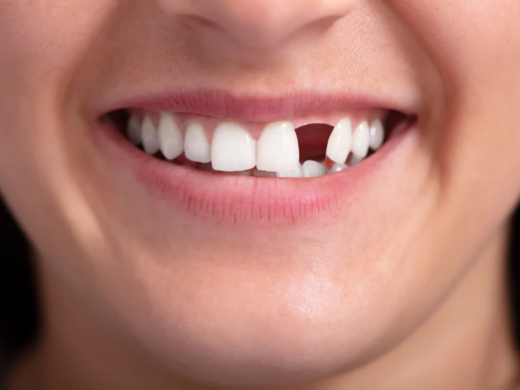 Missing single or multiple teeth