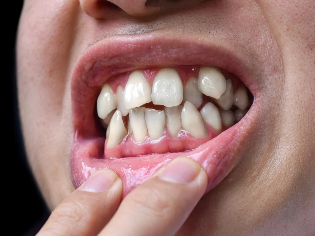 Noticeably misaligned teeth