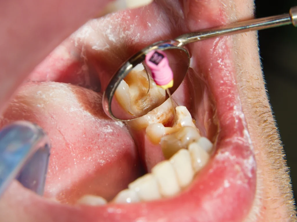 Root Canal Treatment (RCT)
