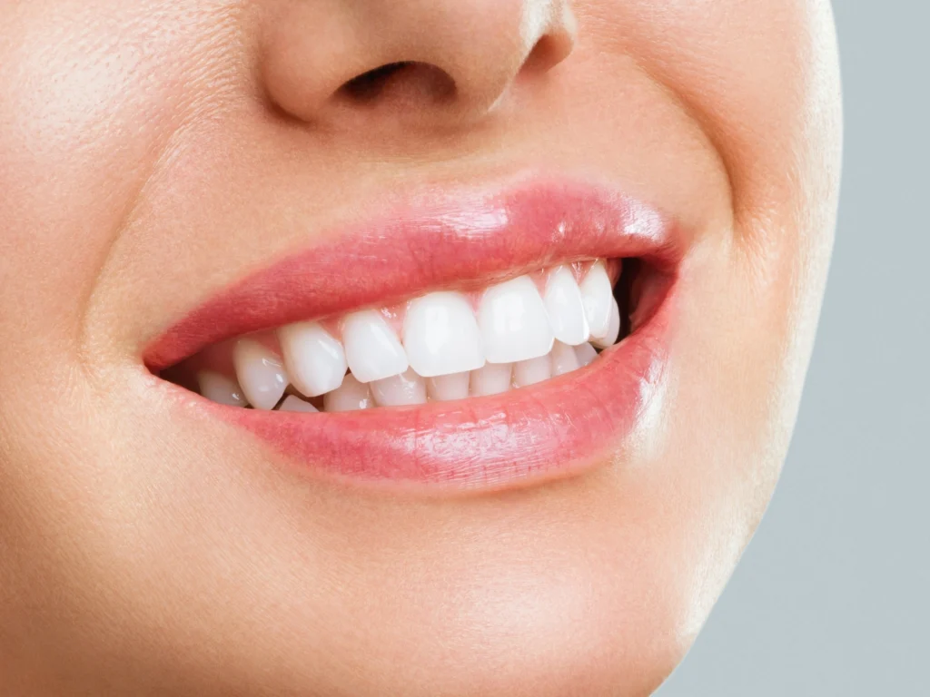 Teeth Whitening