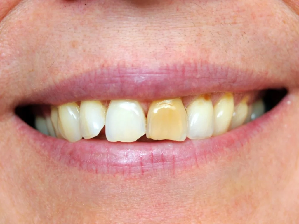 Tooth Discolouration
