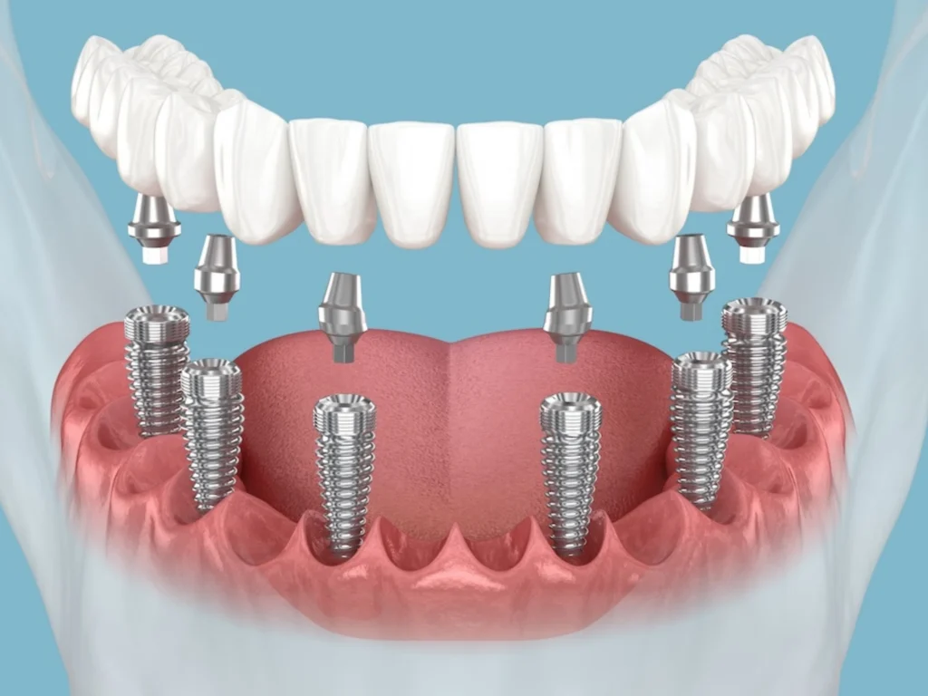 All-on-6 Dental Implants