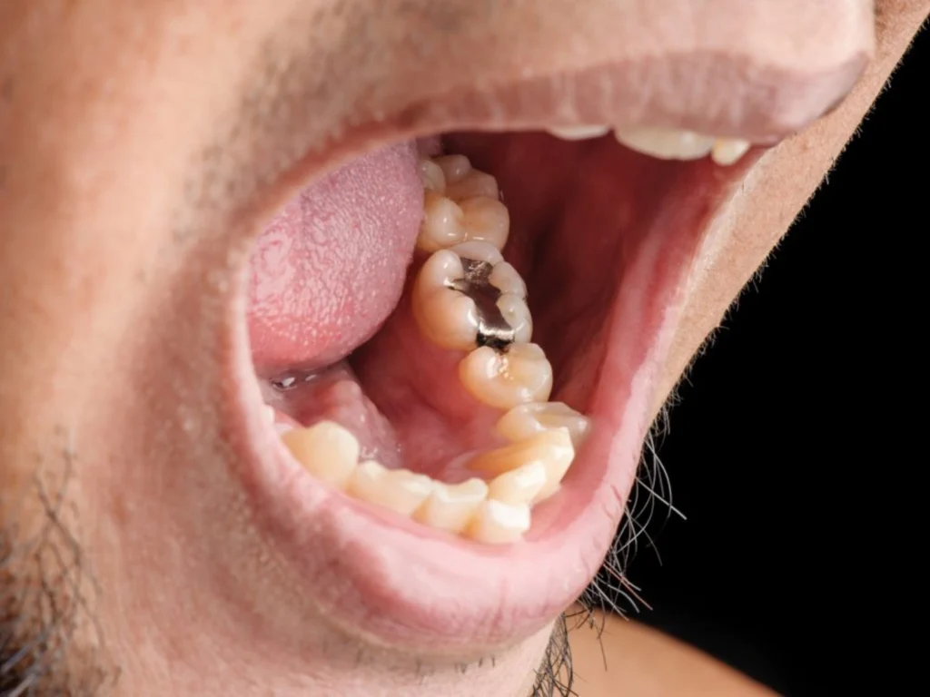 Amalgam Fillings