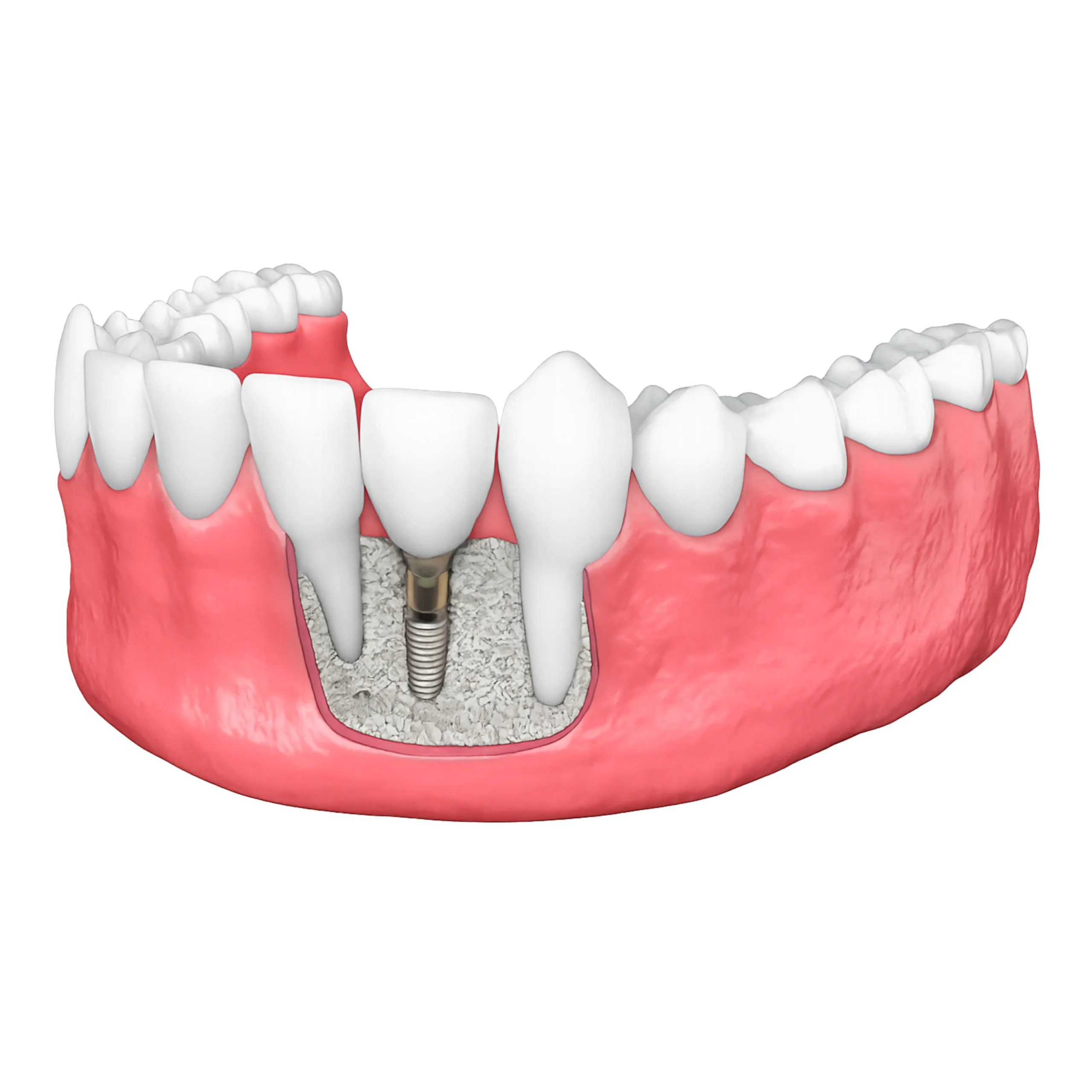 Bone Grafting & Sinus Lifting Preparing Your Jaw for Full Mouth Implants