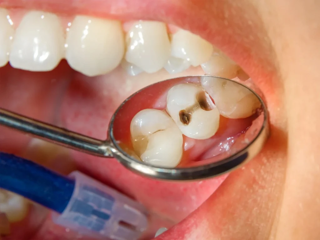 Cavity Treatment and Tooth Fillings