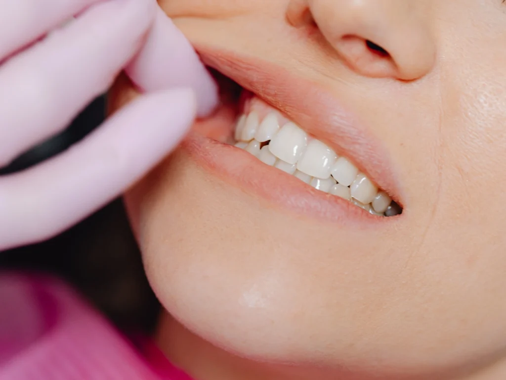 Complete or Full Bony Impacted Wisdom Teeth