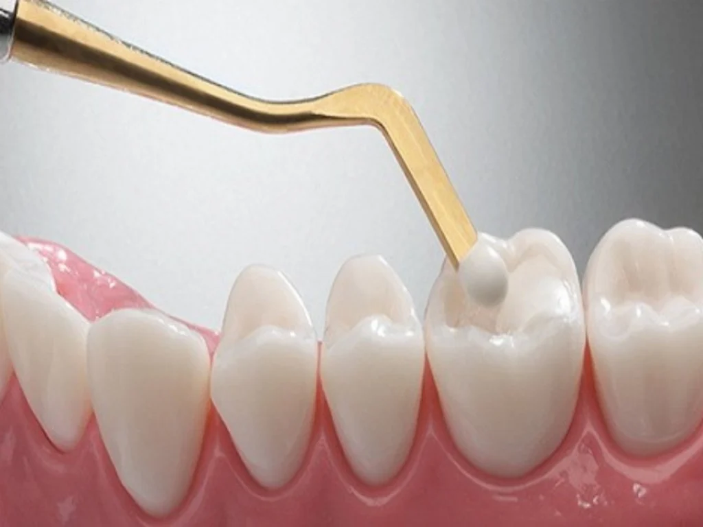 Composite (White) Fillings