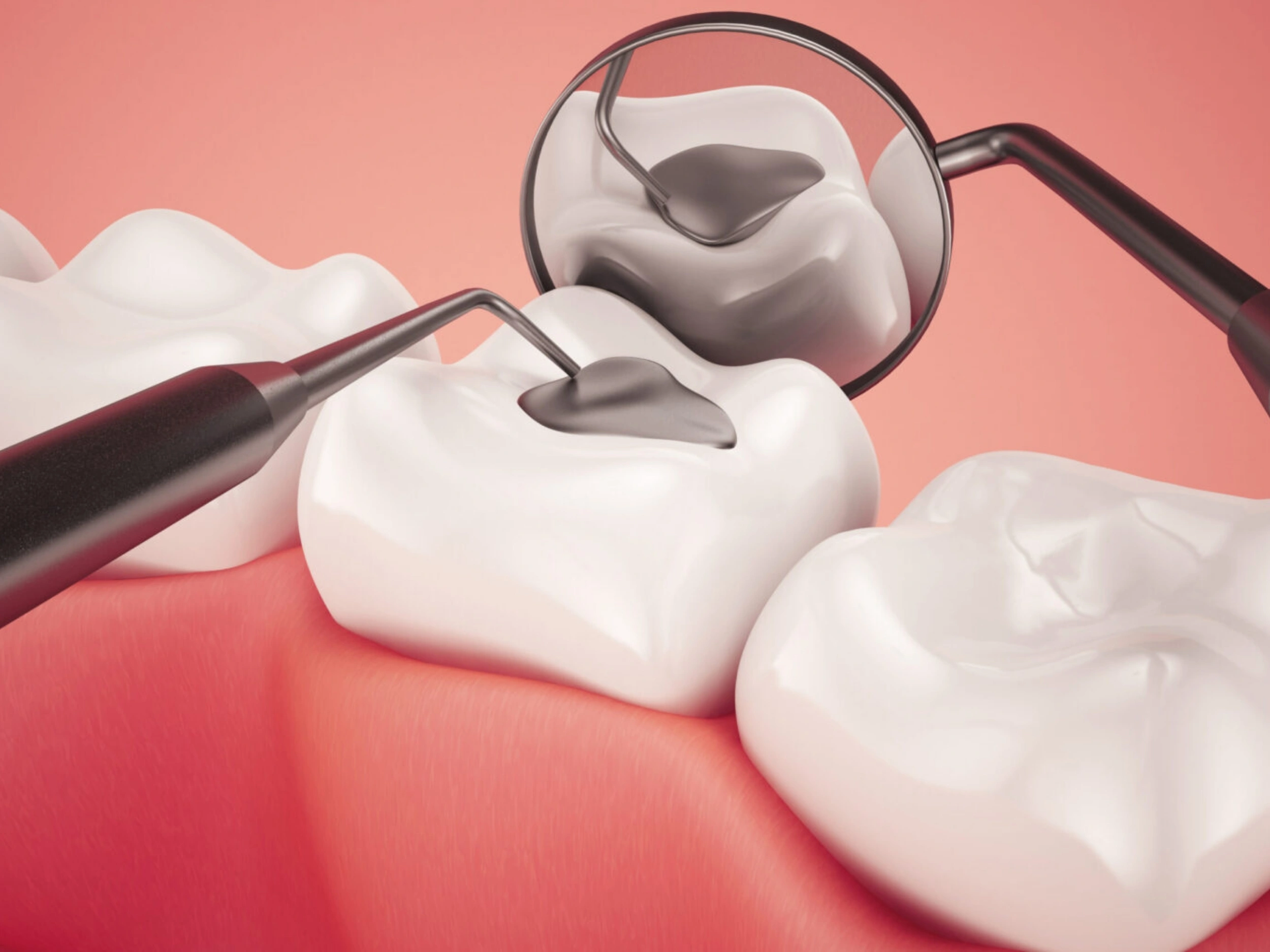 Cost of Tooth Filling Treatment in Surat