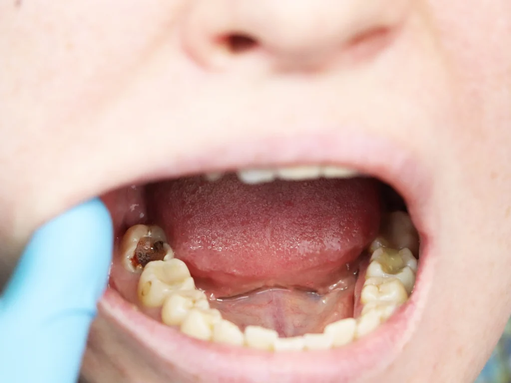 Crowns (For Larger Cavities)
