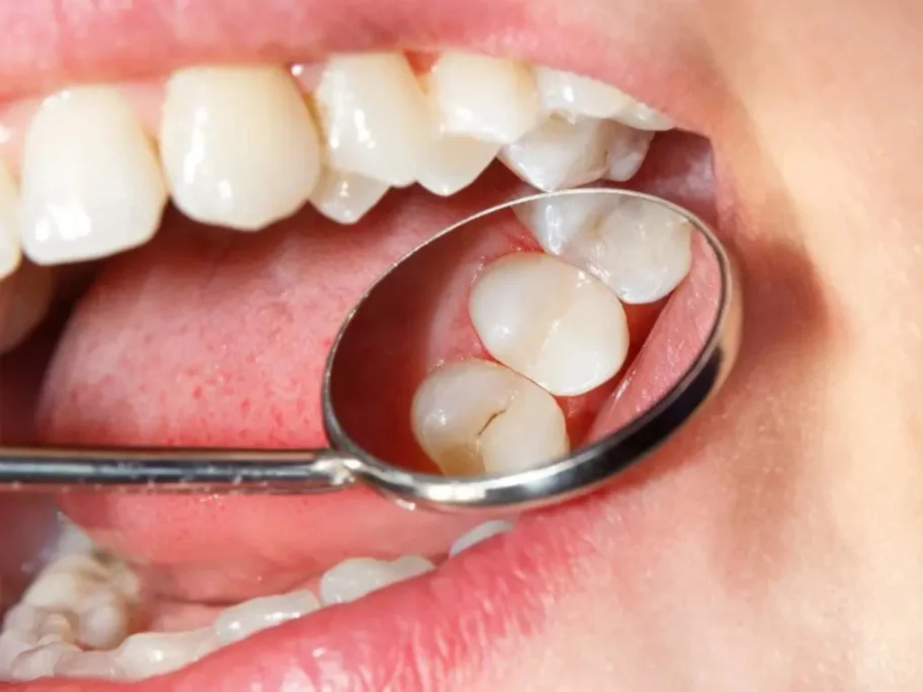 Dental Fillings