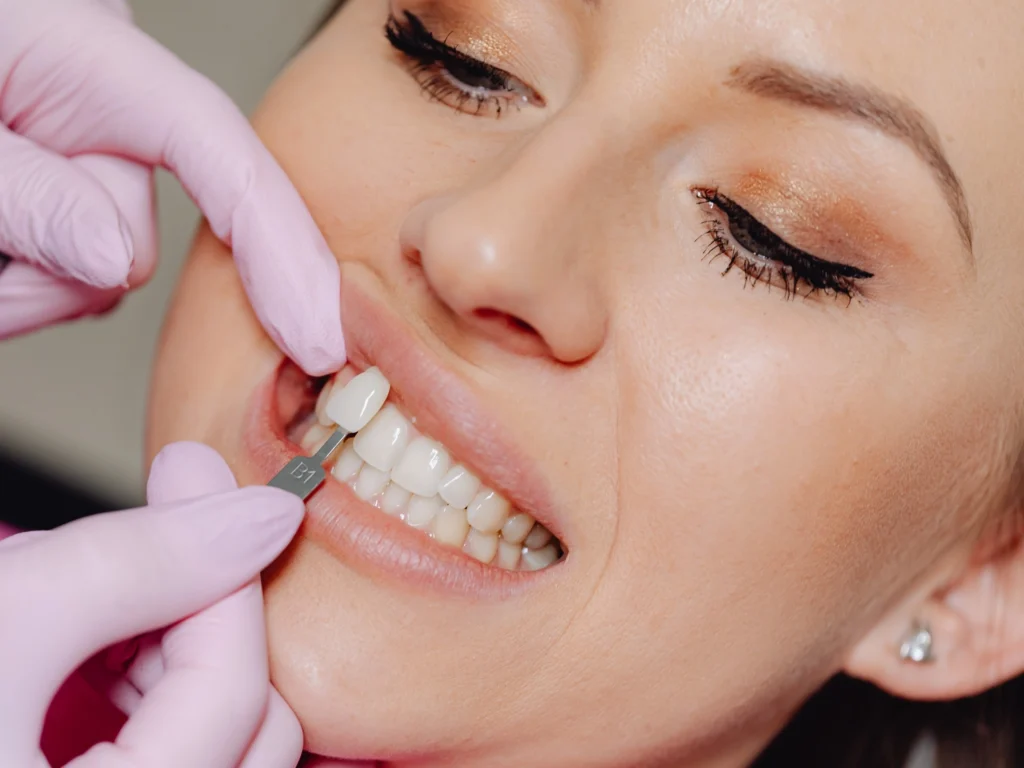 Dental Veneers