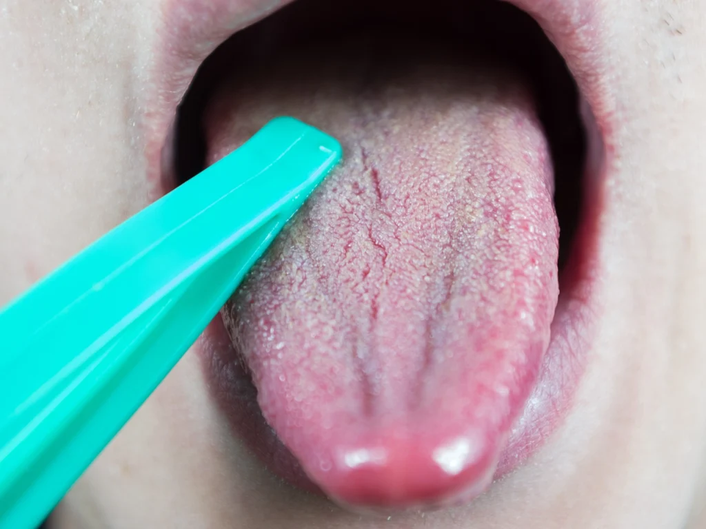 Dry Mouth Treatment