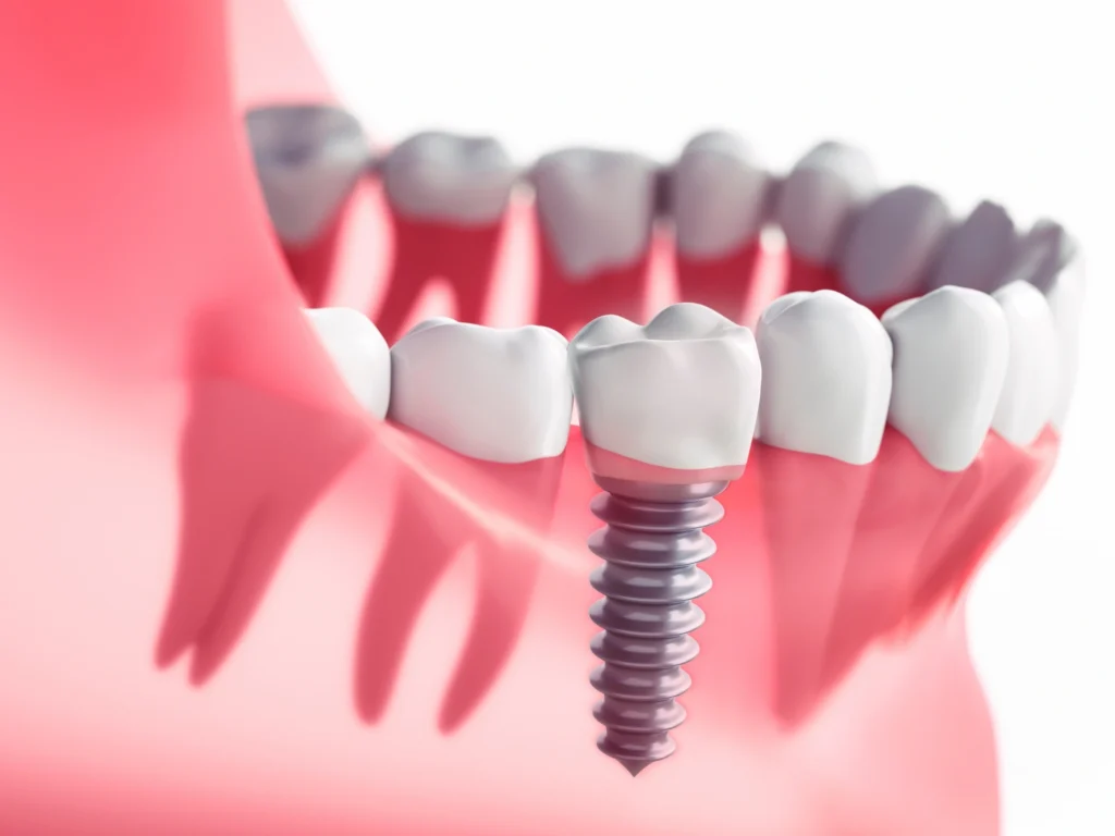 Full Mouth Rehabilitation with Multiple Individual Implants
