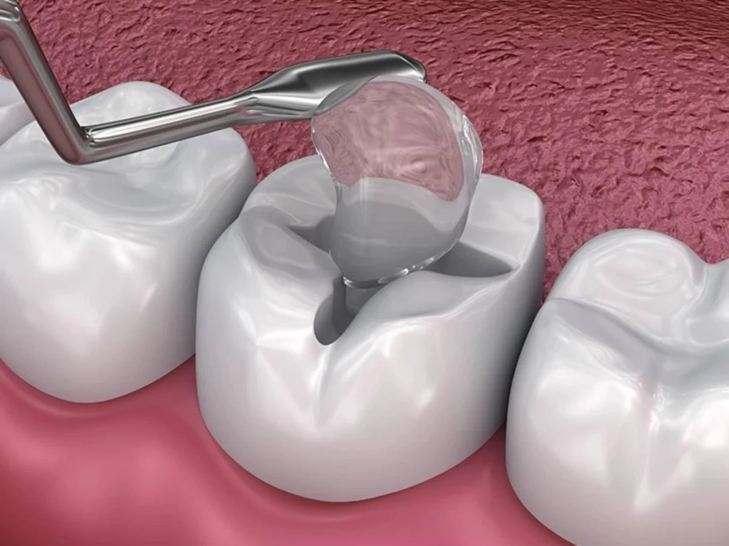 Glass Ionomer Fillings