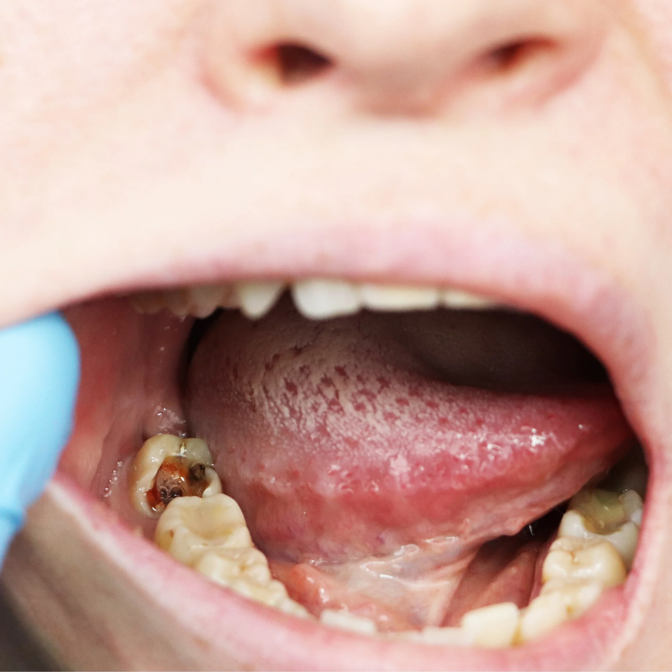 Cavities Are Diagnosed