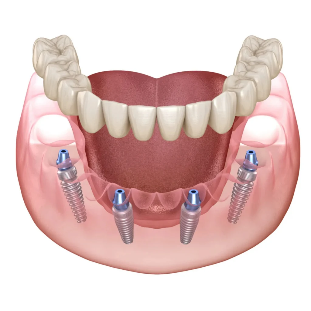 How Much Do Full Mouth Implants Cost in Surat