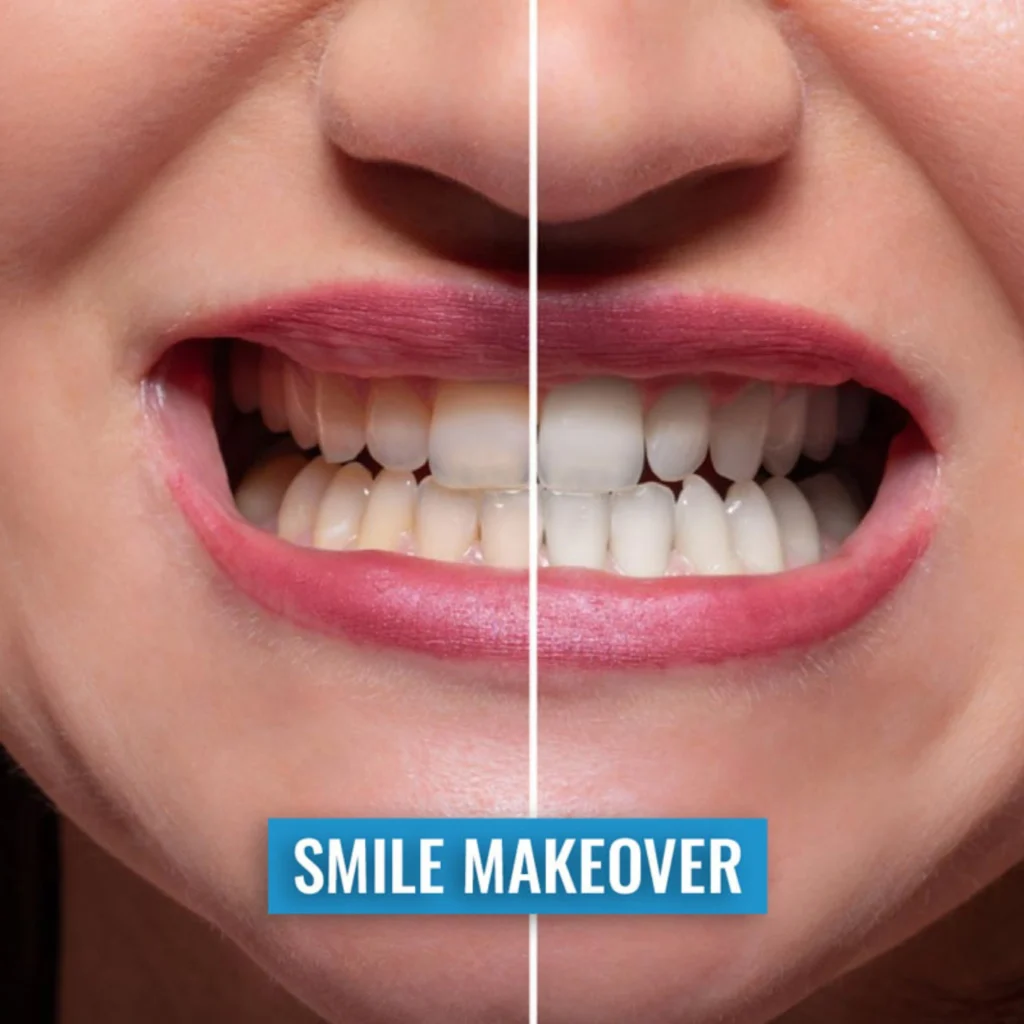 How Much Does a Smile Makeover Cost in Surat