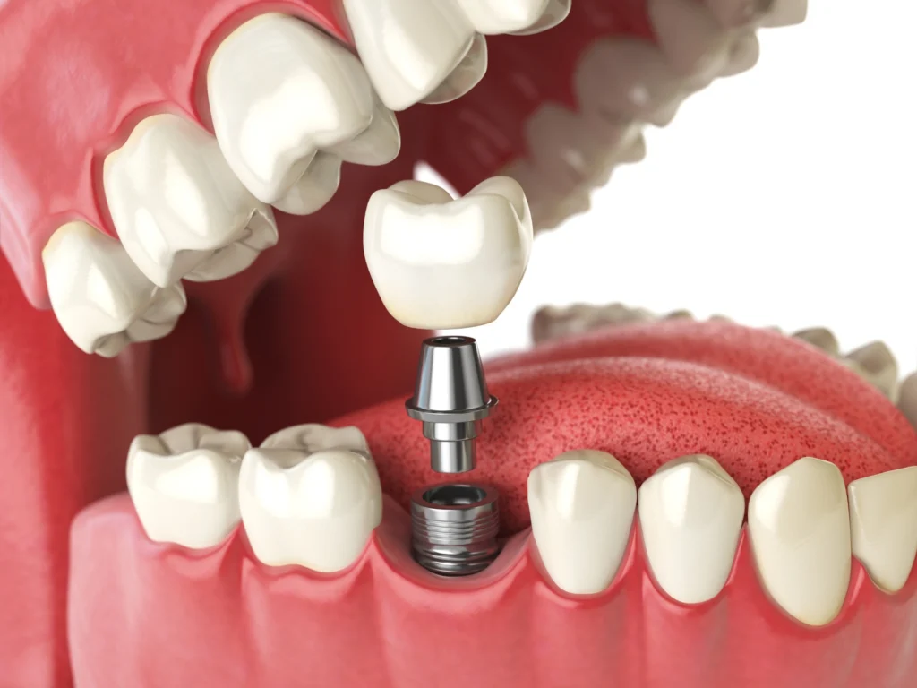 Implant-Supported Fixed Dentures