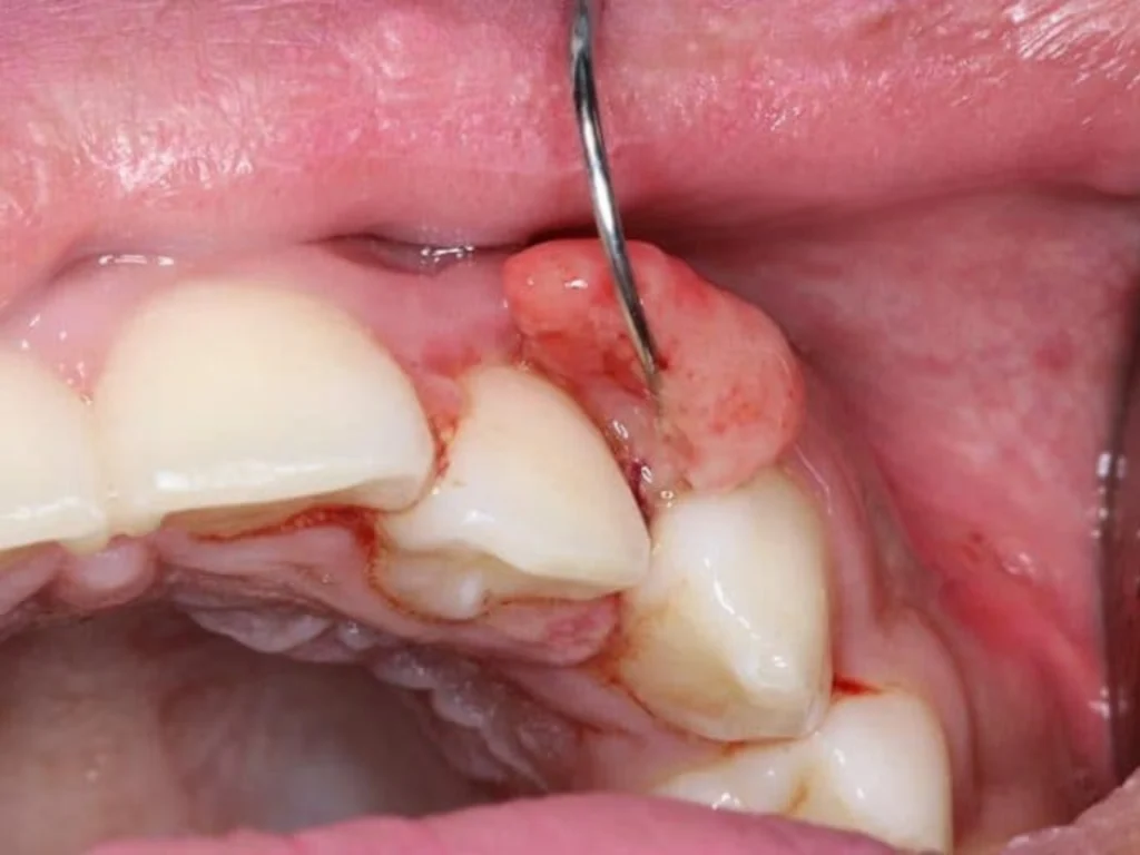 Laser Biopsy & Lesion Removal