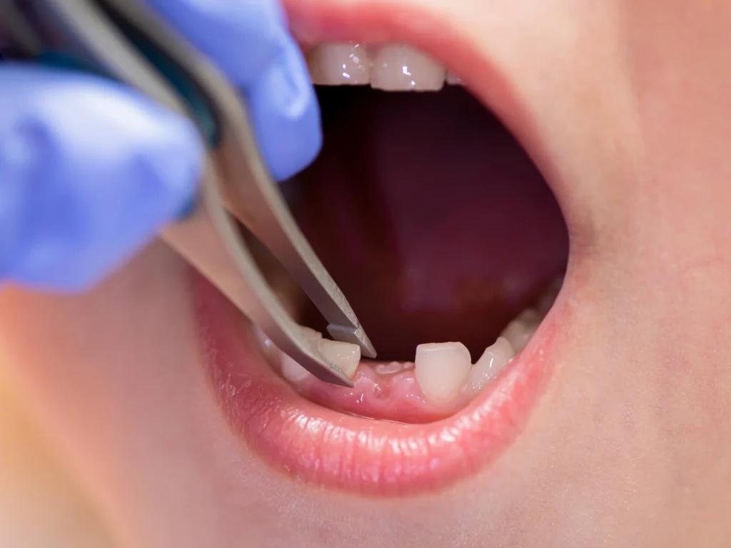 Nonimpacted Wisdom Teeth Removal
