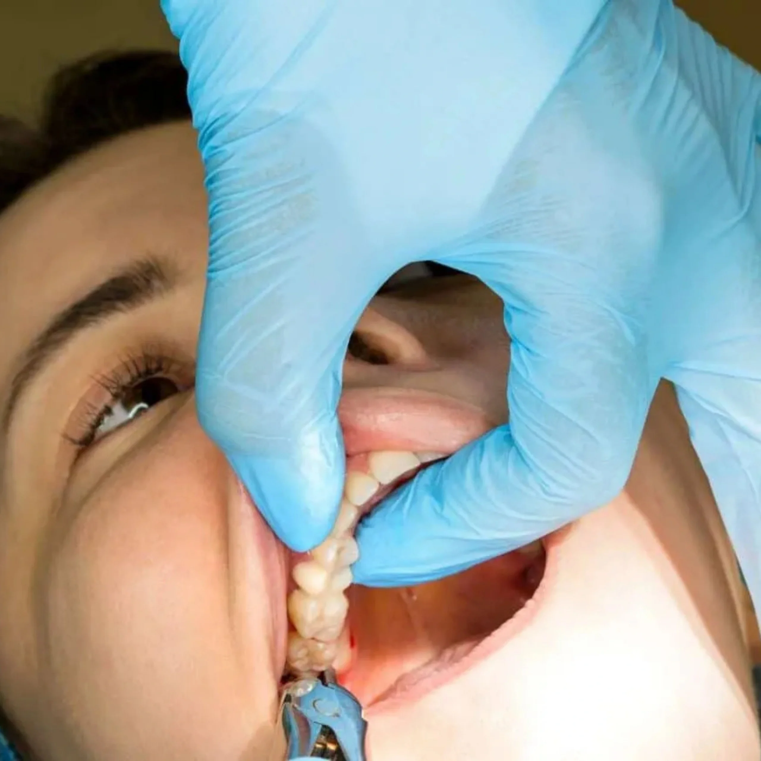 Our Wisdom Tooth Extraction Procedure In Surat