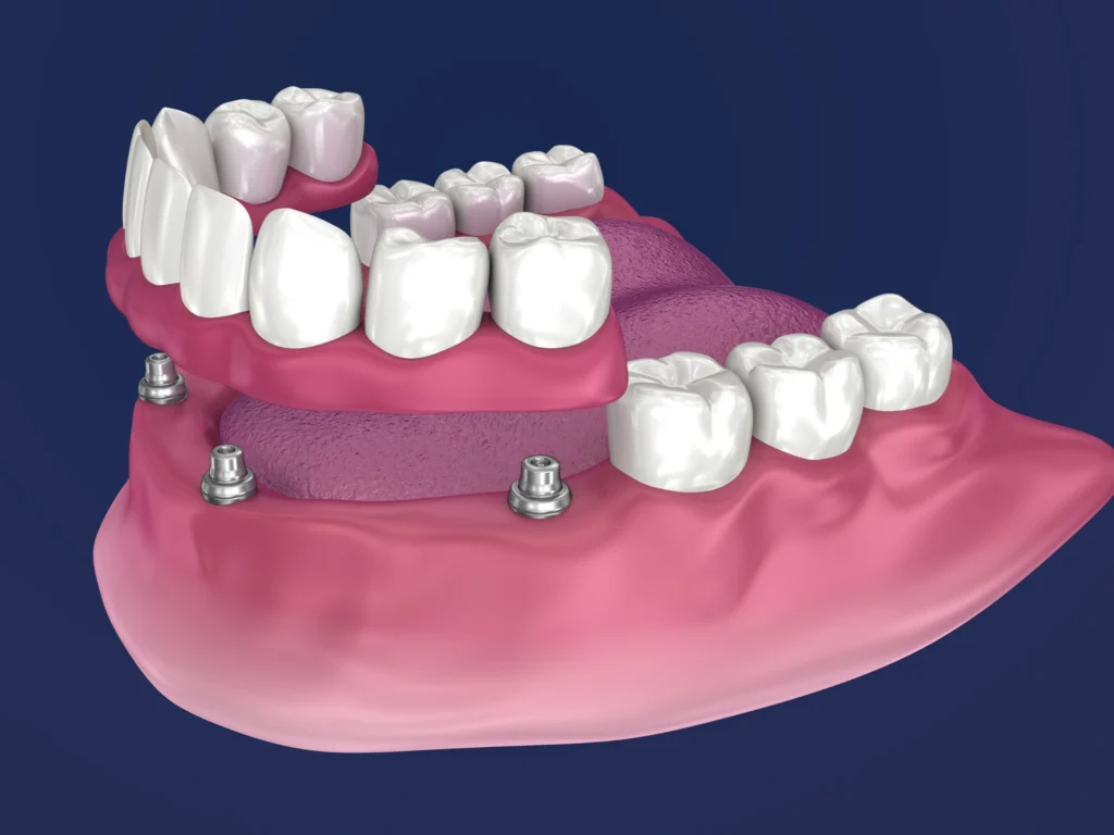 Overdentures