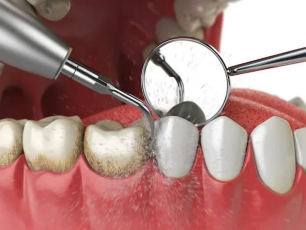 Professional Dental Cleaning