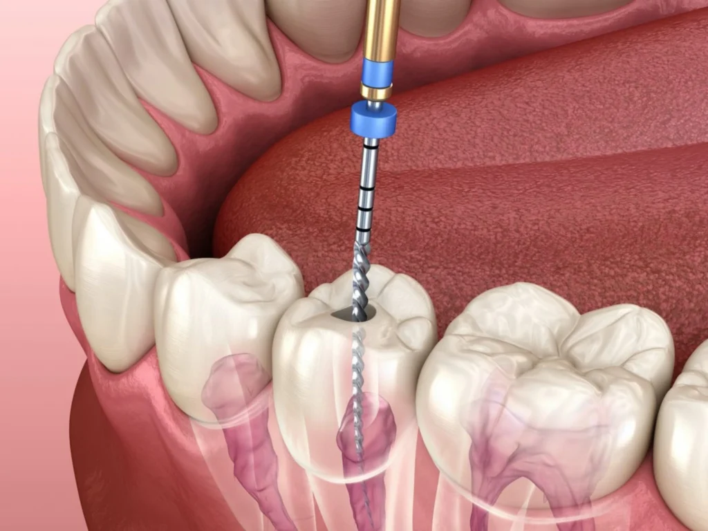 Root Canal Therapy (If Needed)