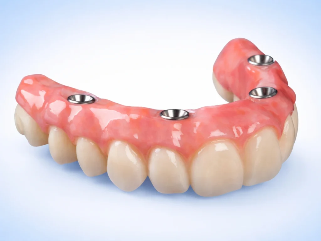 Implant-Retained Overdentures (Removable)
