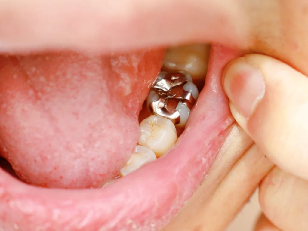 Same-Day Dental Crowns