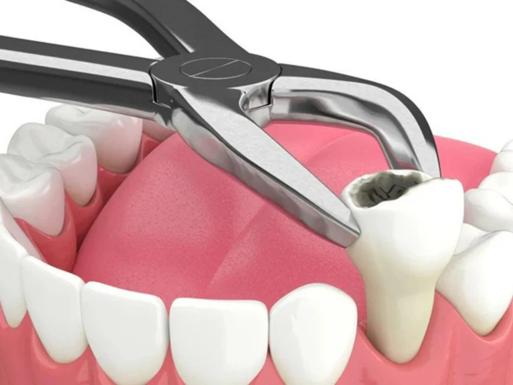 Simple Extraction