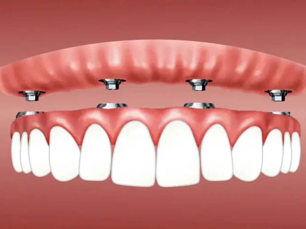 Snap-in Dentures