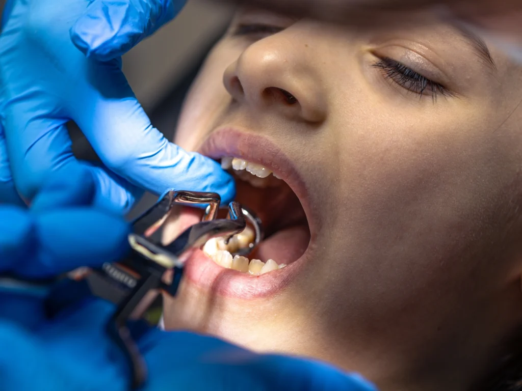 Surgical Extraction (For Impacted Teeth)