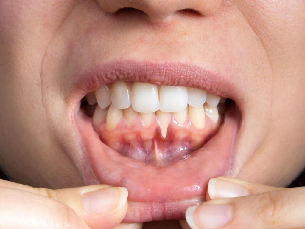 Treatment for Gum Disease