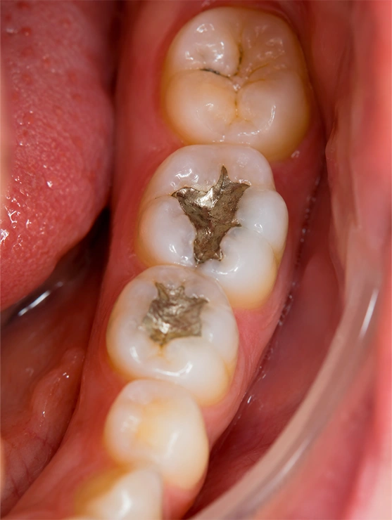 Dental Fillings