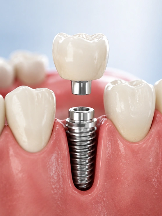 Dental Implants