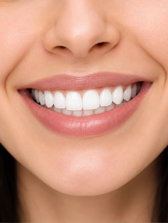 Smile Makeover