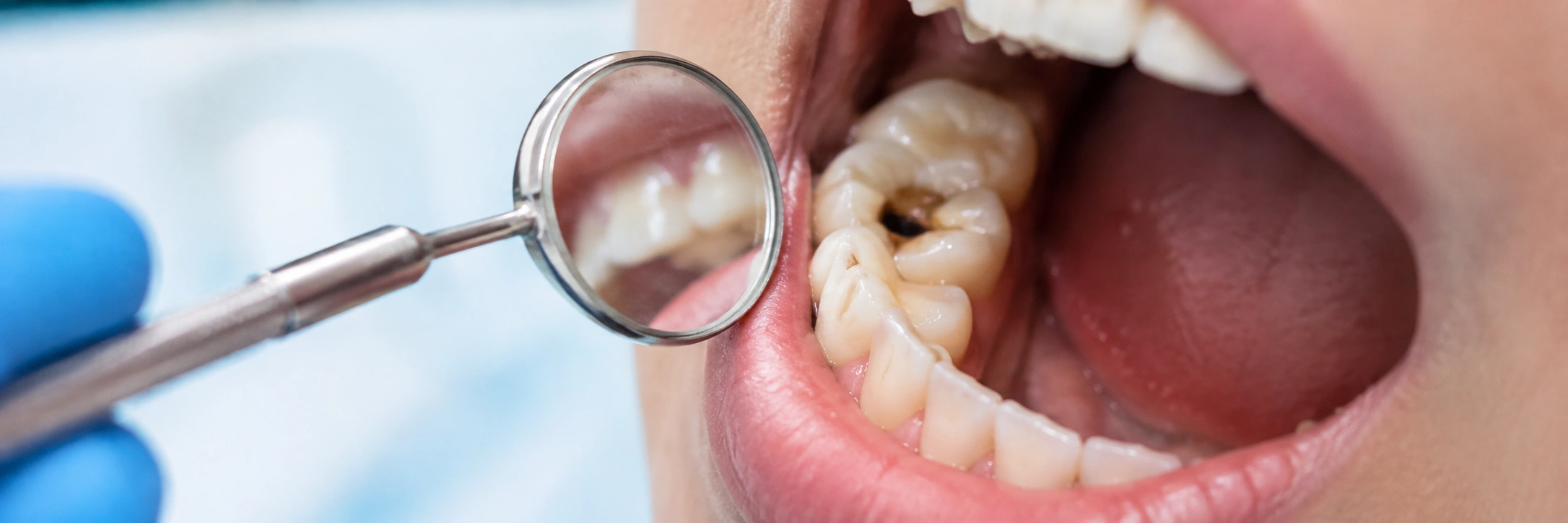 Tooth Decay or Cavities