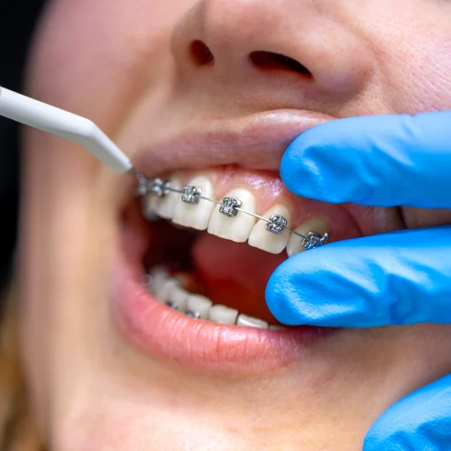 Best Orthodontist in Surat for Braces & Teeth Alignment