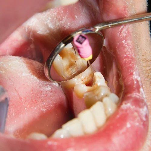 Root Canal Treatment (RCT)