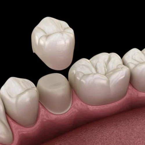Single-Visit Crowns